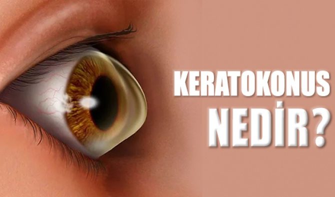 Keratokonus Nedir? Nasıl Tedavi Edilir?